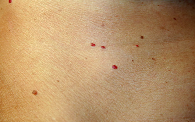 How To Treat Red Spots On Skin With Ayurvedic Remedies? – Vedix